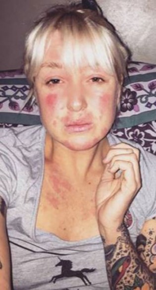 L'allergia di Caitlin